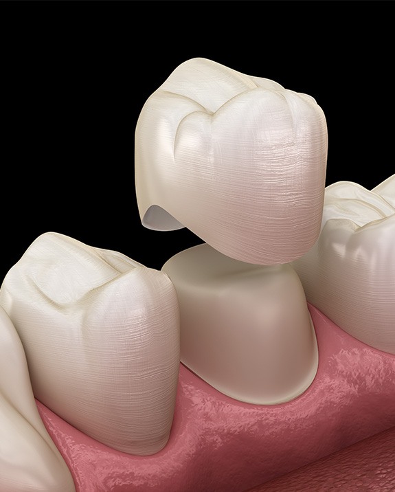 A computer illustration showing how a dental crown fits atop a tooth