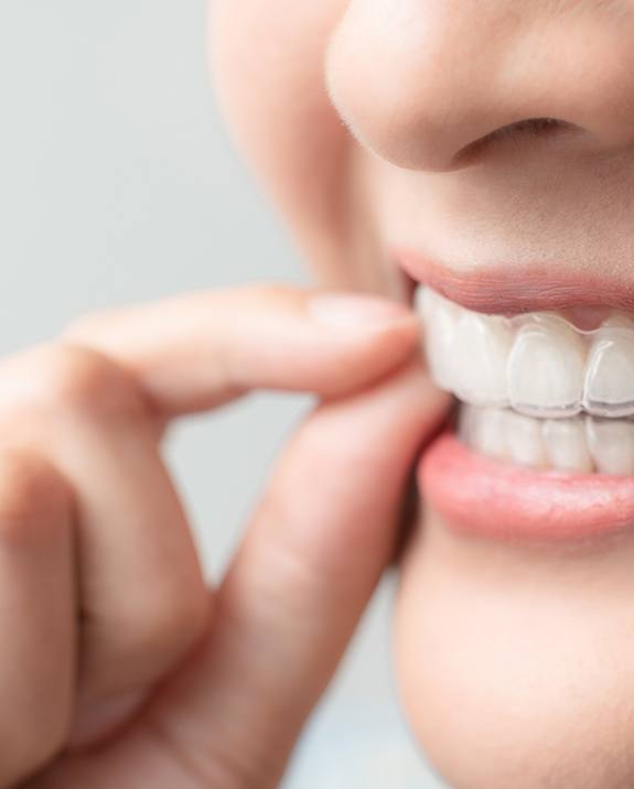 Closeup of patient with clear aligners