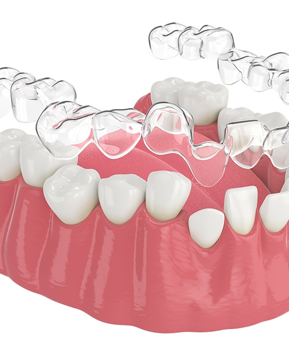 Illustration of clear aligner being placed on bottom teeth