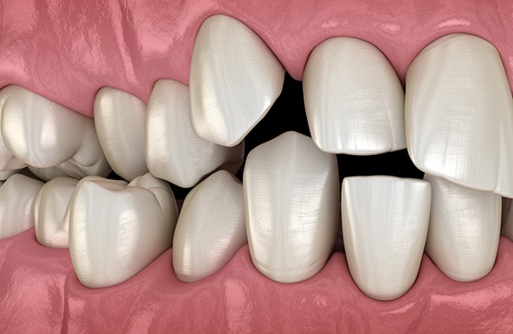 Illustration of spaced out teeth