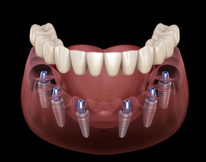 Illustrated full denture being placed onto six dental implants